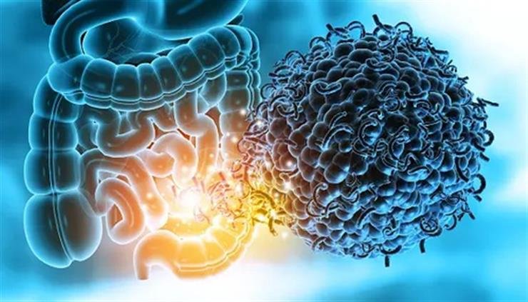 Study shows how gut microbiome raises risk of multiple sclerosis