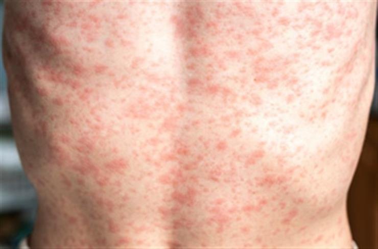 Health alert issued for measles outbreak in Australia's Victoria state