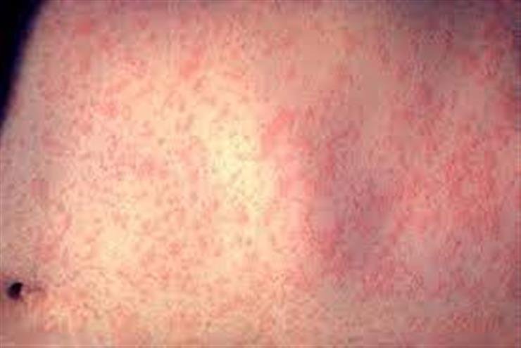 Measles outbreak spreads in US