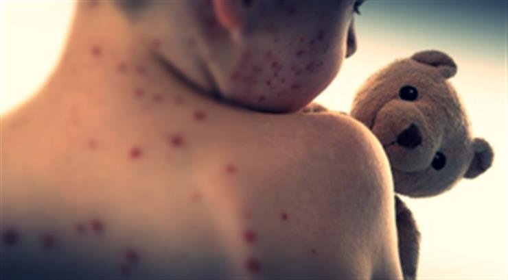 Mongolia's measles cases surpass 200