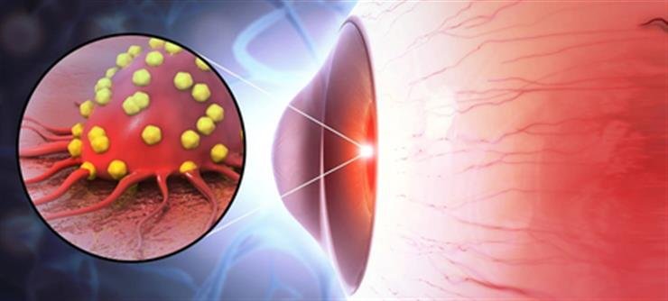 Study shows new drug delivery system effective against rare eye cancer
