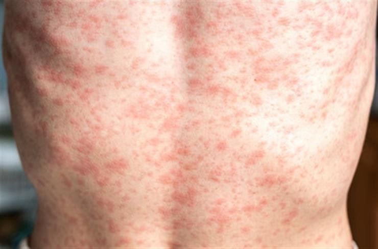 US faces resurgence of measles cases as vaccination rates decline: Study