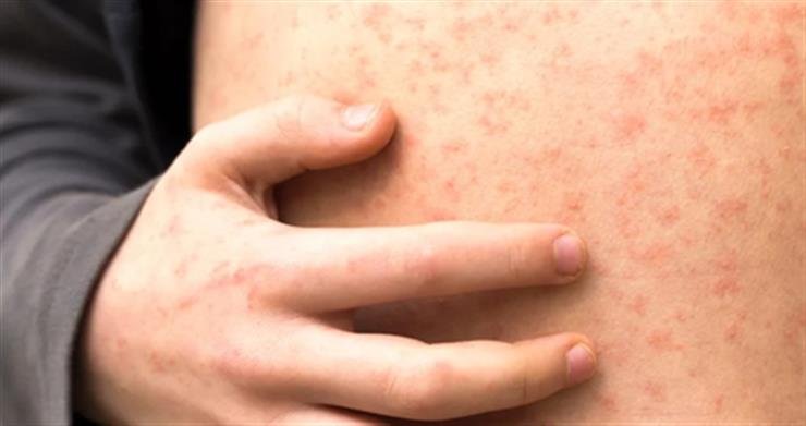 Texas outbreak could upend measles elimination claim by US